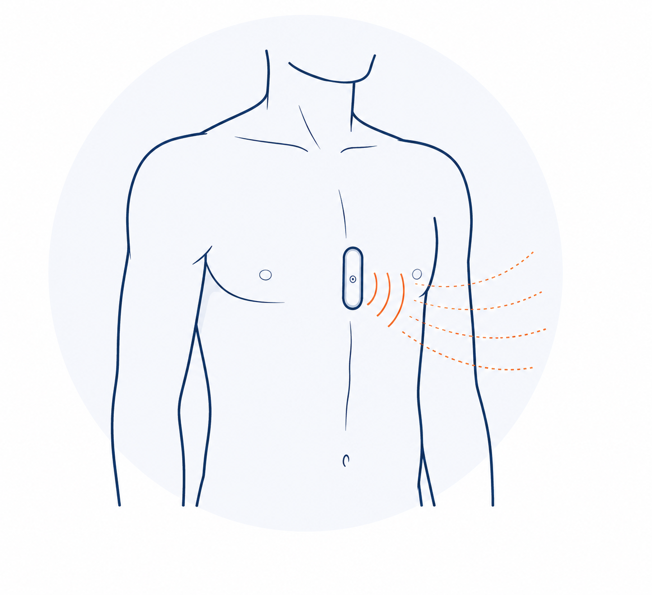 Subcutaneous cardiac sensor positioned in the chest